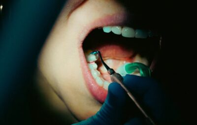 Czy piaskowanie zębów usuwa kamień nazębny?