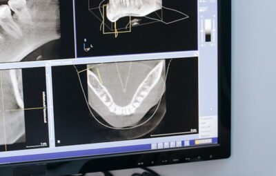 RTG punktowe zęba – kiedy jest potrzebne?